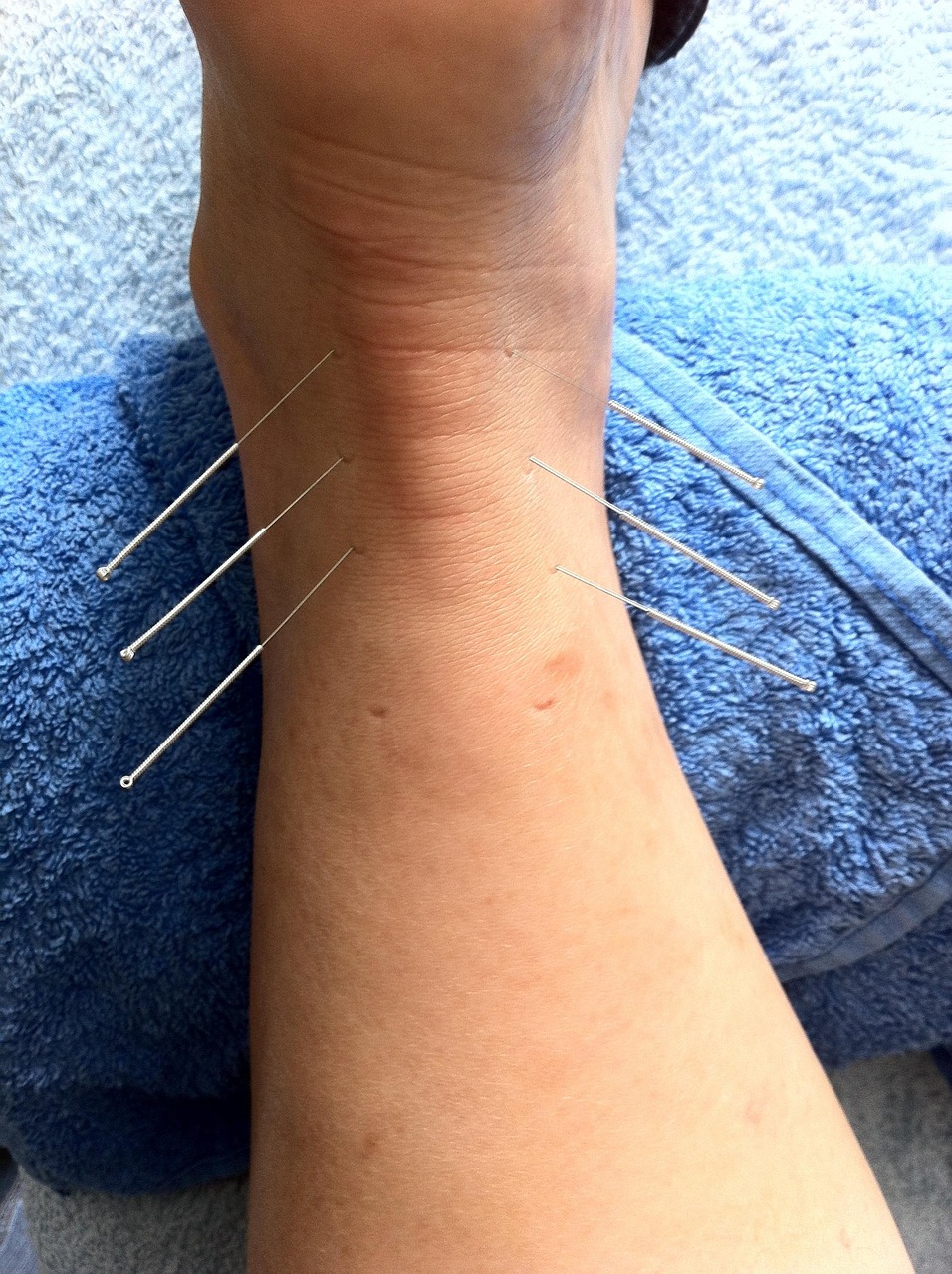 acupuncture, sport injury, sports massage, alternative, injured, injury, leg, healing, holistic, achilles heel, fish bone, acupuncture, acupuncture, acupuncture, acupuncture, acupuncture